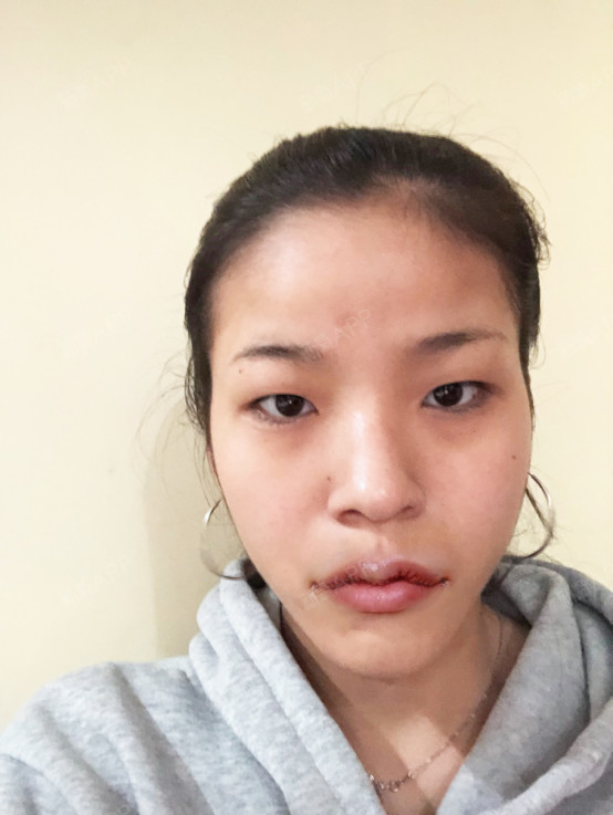 杭州m唇手术好不好_效果图_公主牌m唇手术术后第1天_新氧美容整形