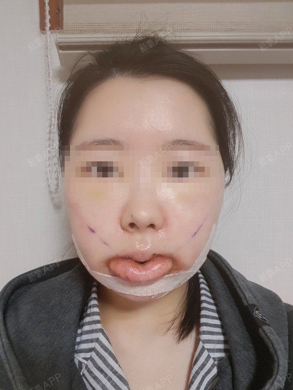 上下颚手术/突嘴矫正好不好_效果图_氧气zs81r上下颚手术/突嘴矫正术