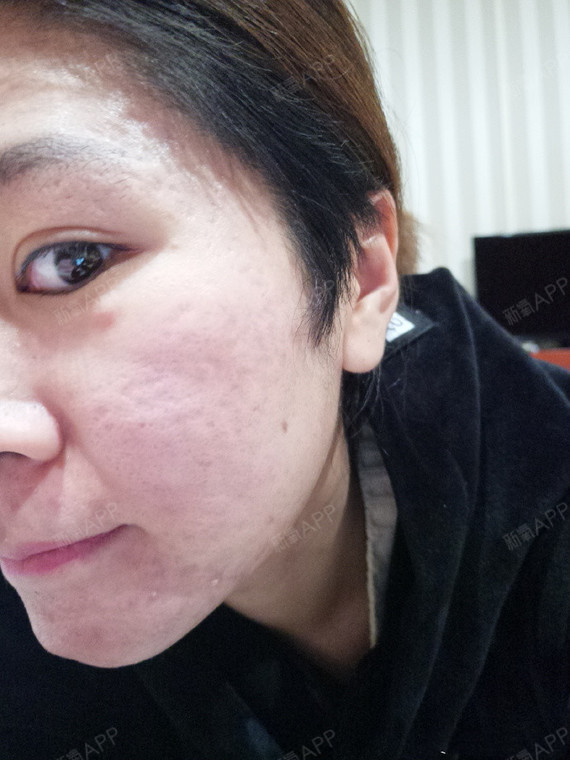 day8,痘坑治疗第八天,晚上室内灯下.感觉太阳穴_圈子-新氧美容整形