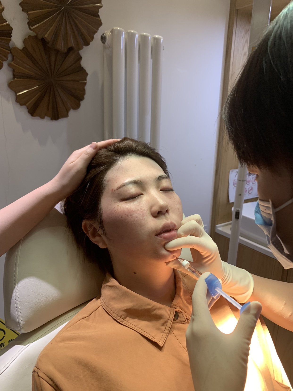 玻尿酸垫下巴第0天