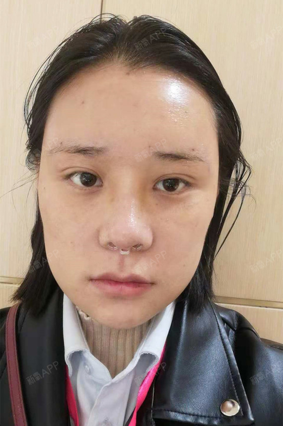 宁霜雪自体脂肪全脸填充第10天美丽日记