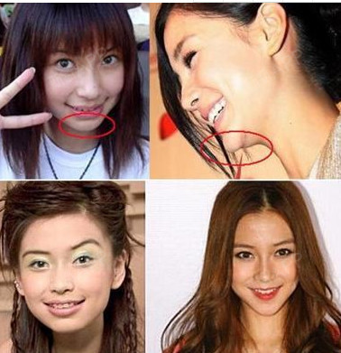 传言假体隆下巴后会"移位",分分钟帮你扫盲!