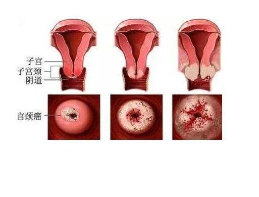 子宫癌真实图片 早期图片