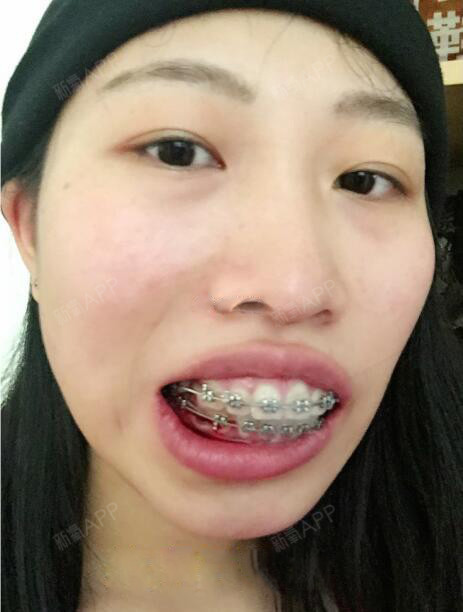 现在我的牙齿一直矫正的很好,我也看到很多矫正的案例,希望能够有效果