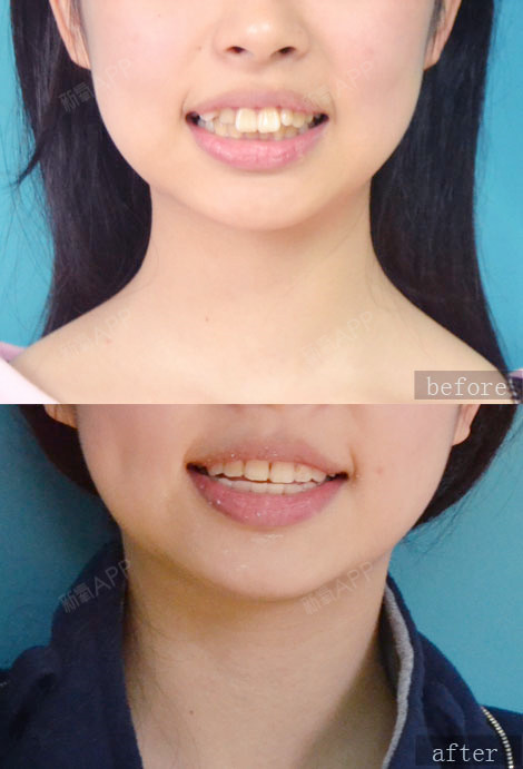 保持器不戴它你的牙就白整了!