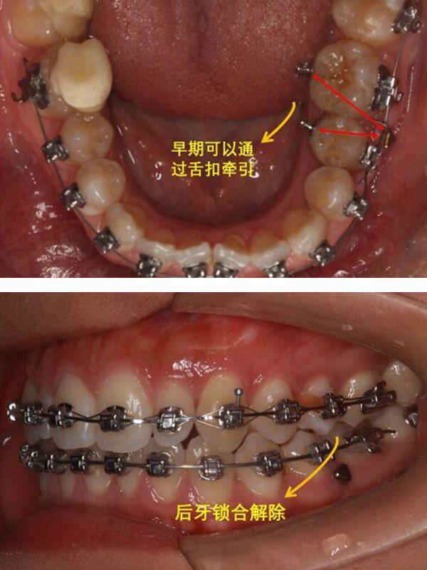 矫牙打骨钉,到底痛不痛?寒假来袭[:13][:13_圈子-新氧美容整形
