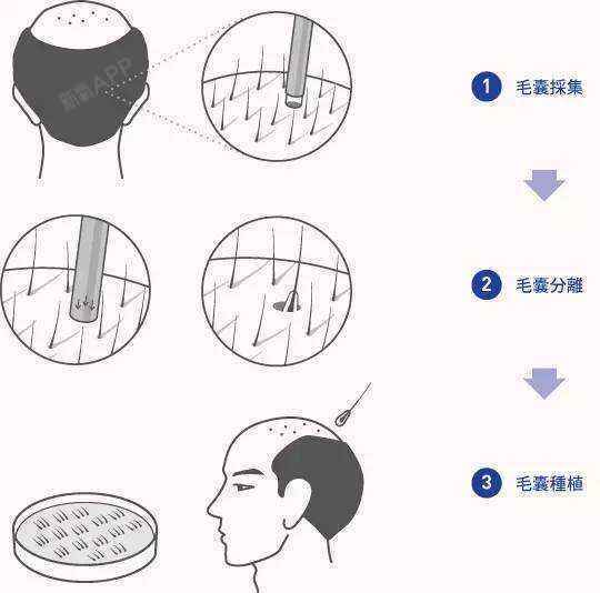 所有的发际线问题都在这里所有的发际线问题归根结底就 圈子 新氧美容整形