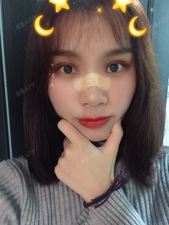 早上起来发现我竟然有三层眼皮了,吓了我一跳,还好过_圈子-新氧美容