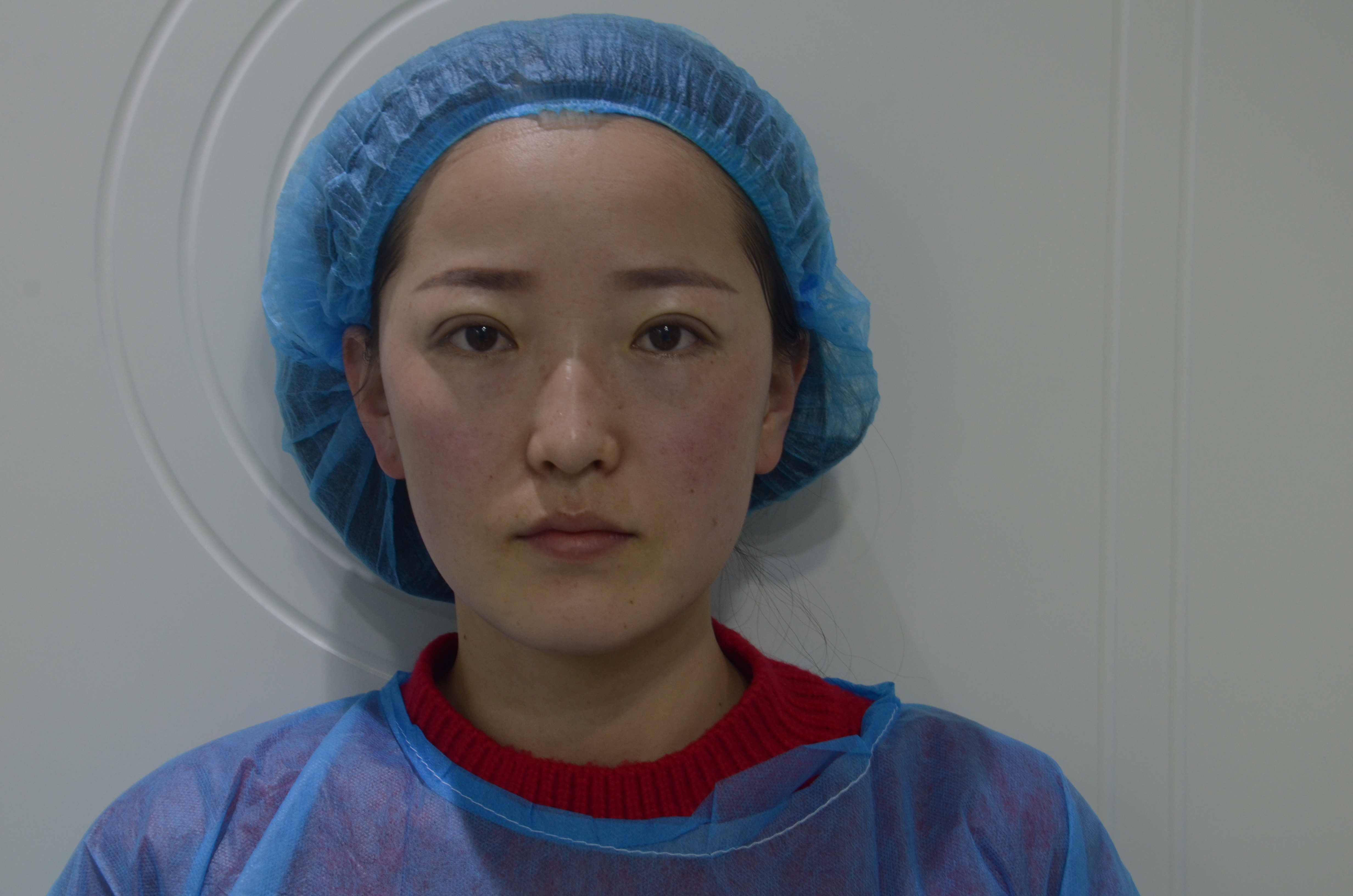 定点双眼皮第0天