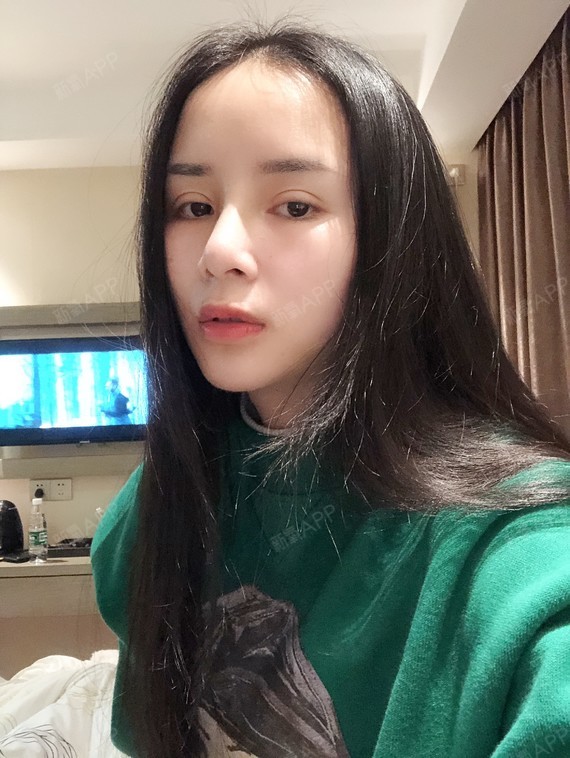 重庆鼻部多项好不好_效果图_鑫宝宝emmm鼻部多项术后第28天_新氧美容