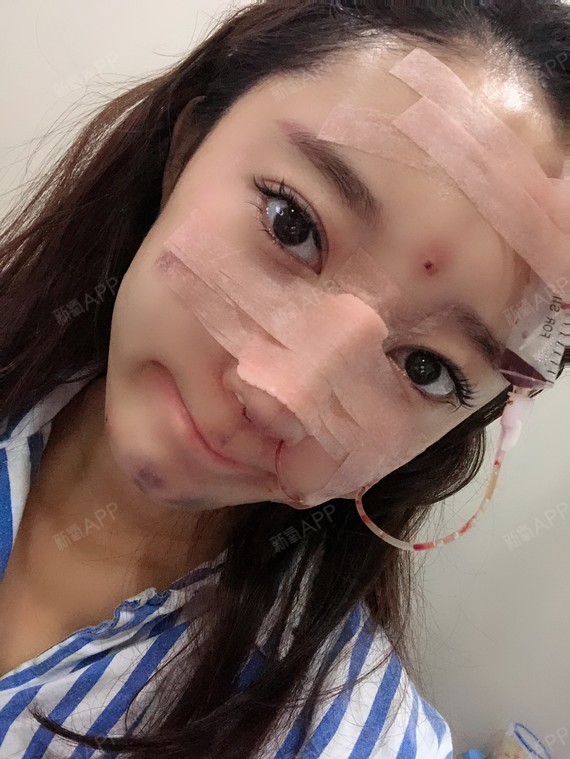 做完手术的第一天,插着引流管,夹着鼻夹,鼻子上还包_圈子-新氧美容