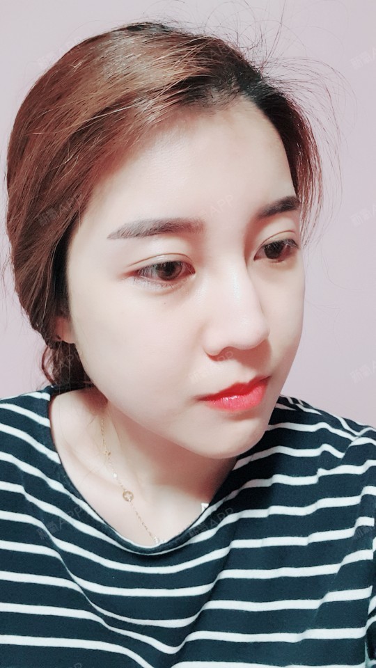 小脸静静颧骨颧弓整形术第10天美丽日记-新氧