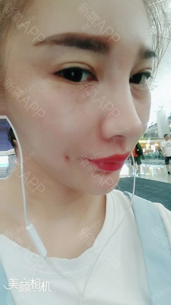 做完以后不得不说,现在酒窝的技术已非常成熟,做好的_圈子-新氧美容
