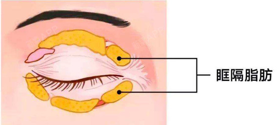 除了内取眼袋和外切去眼袋之外,原来还有眶隔脂肪释放术,这个手术优势