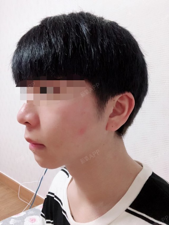 尤克里上颚前突/天包地术后第23天美丽日记_新氧整形