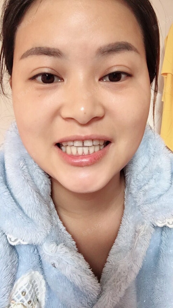 上海隐形托槽矫正好不好_效果图_你若盛开蝴蝶自来s隐形托槽矫正术后