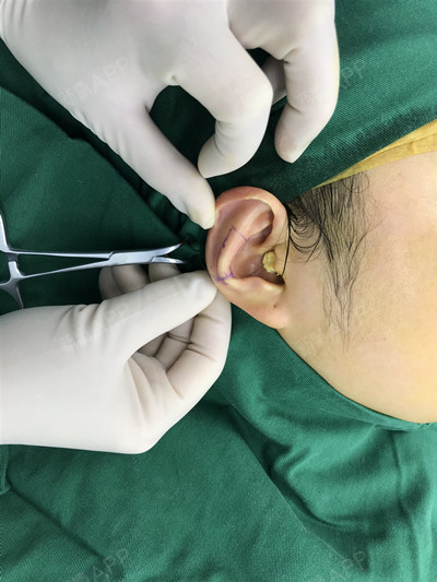 但是还是在4点多的时候打我电话说可以帮我做手术 我只矫正一只耳朵