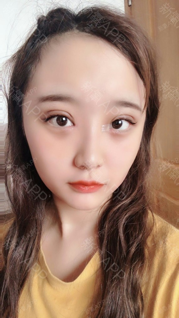 双眼皮 内眼角术后7天.做完双眼皮唯一的感觉就_圈子-新氧美容整形