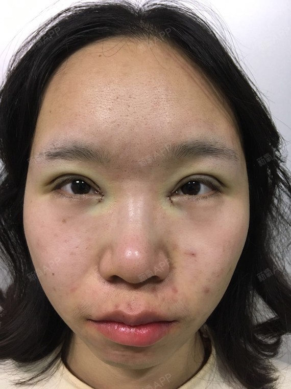 "豆豆眼"也是一种很典型的眼型,看上去眼睛小如豆子_圈子-新氧美容