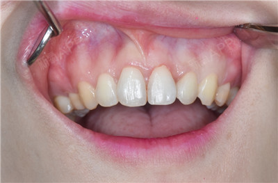 vivi陈星牙龈炎第1天美丽日记-新氧美容整形