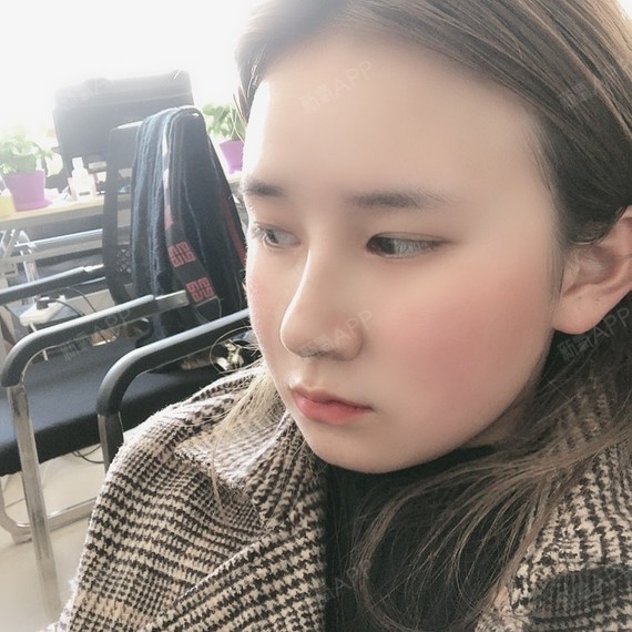 我是一个人生活肋软骨隆鼻第7天美丽日记