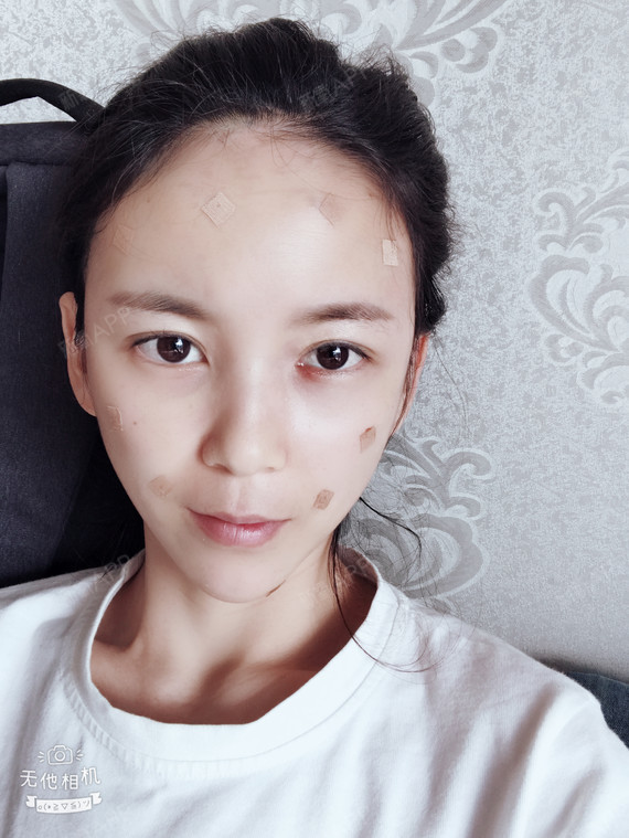 自体脂肪面部填充