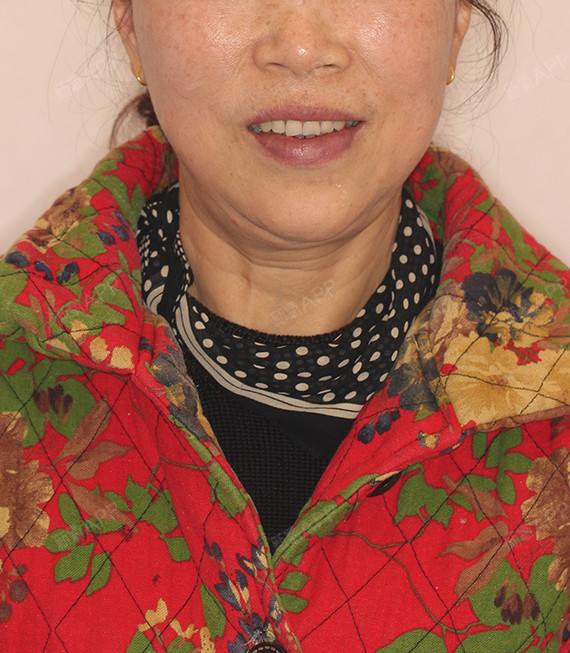 效果很满意,特别王春_圈子-新氧美容整形