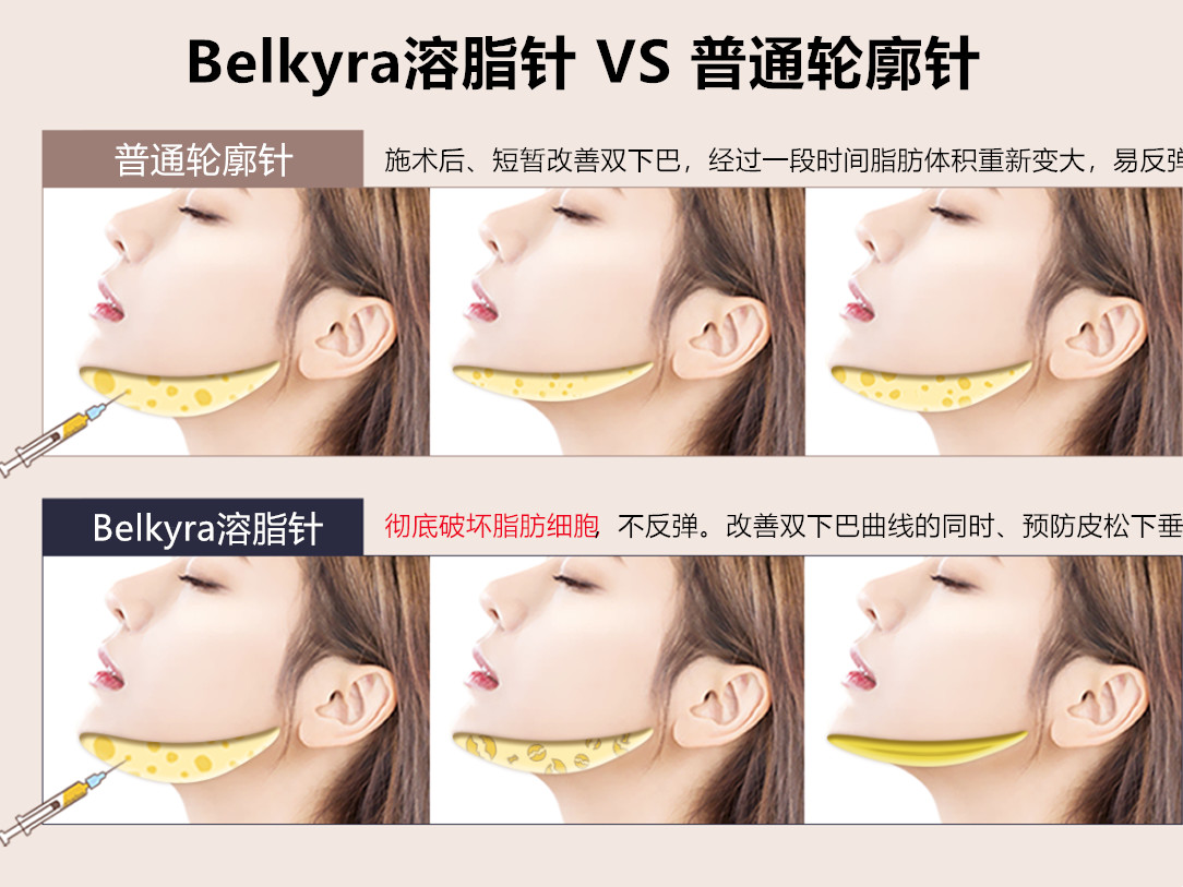 韩国火到爆炸的项目"belkyra溶脂针",针对双下巴的溶脂类注射.