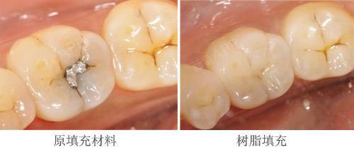 蟲牙就是牙齒裡面長蟲子嗎?相信你還不知道