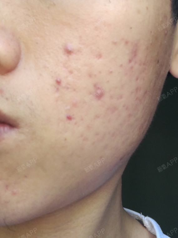 扁平疤痕 凹陷性疤痕