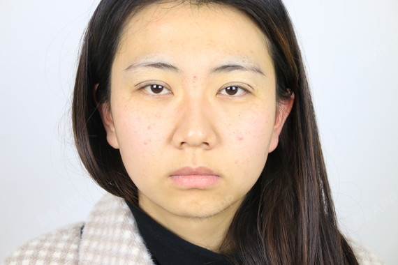 今日案例分享:眼窝凹陷不严重的话可尽早做双眼皮手术_圈子-新氧美容
