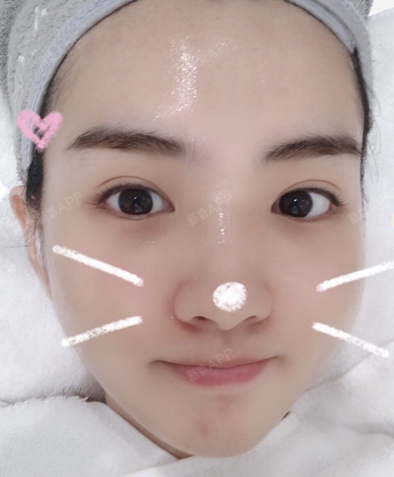 无针水光好不好_效果图_氧气qqb553c无针水光术后第136天_新氧美容