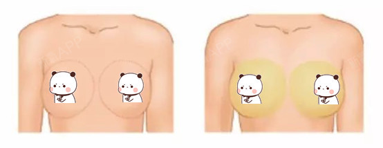 SVF自体脂肪填充普通自体脂肪填充什么是svf