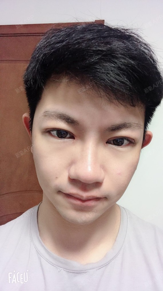 今天正好术后一个月,在家闲着没事,我再写点日记吧