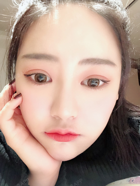 童颜针好不好_效果图_yuki小太阳童颜针术后第23天_新氧美容整形