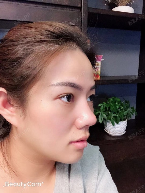 【假体隆鼻 耳软骨修鼻尖 鼻中隔移植鼻小柱延长 鼻_圈子-新氧美容