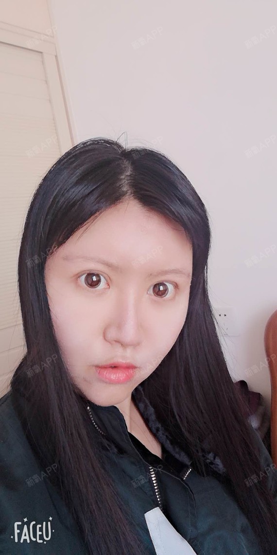 做完自体脂肪填充也有十天了,术后需要注意的事项还是_圈子-新氧美容