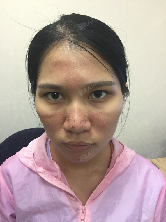 趁着休息,来放一波微针后的恢复照片,[:82]今天_圈子-新氧美容整形