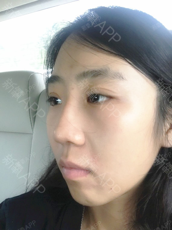 做完玻尿酸隆鼻,已经一个多月了,效果挺好的,鼻子一