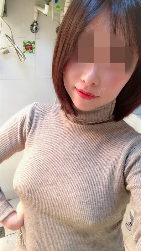 看有的氧气们说做完假体隆胸之后,乳尖偶尔会有麻麻