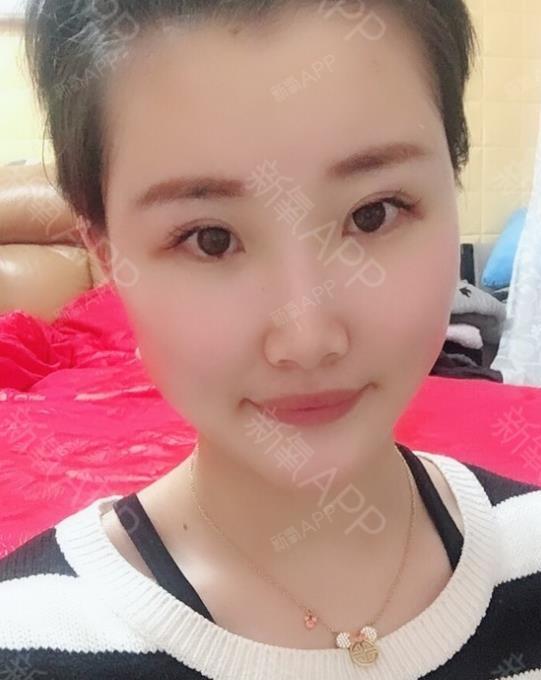 氧气zs0k0玻尿酸丰额头第0天美丽日记-新氧美容整形