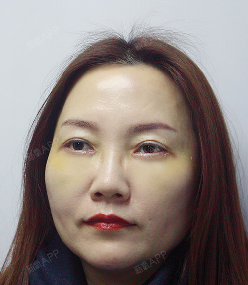 外切去眼袋好不好_效果图_氧气ztqko外切去眼袋术后第9天_新氧美容