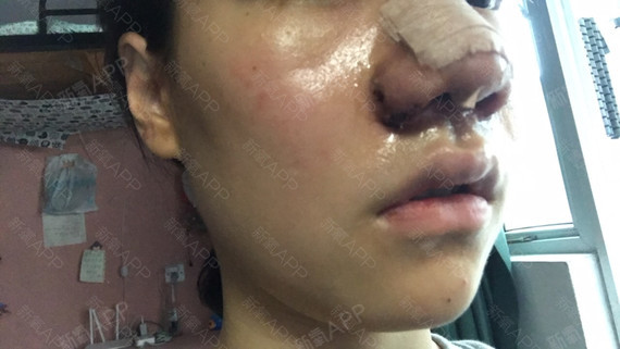 术后第一天,做的是鼻头鼻翼缩小手术,因为其实我的鼻_圈子-新氧美容