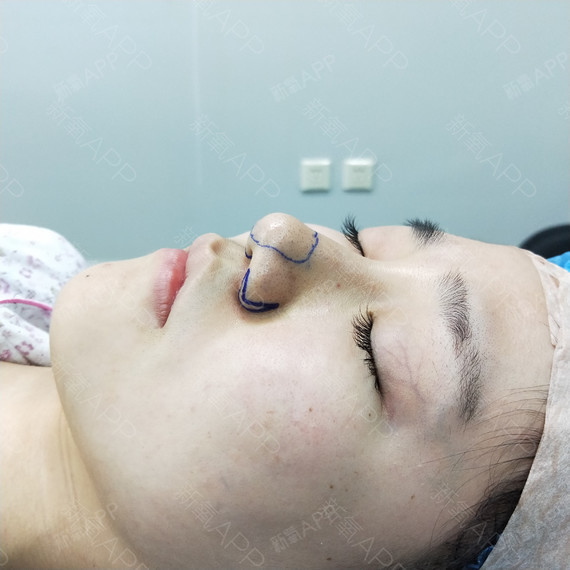 整形鼻部需要多少钱_整形鼻部多少钱_鼻部整形