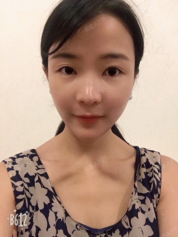 这小尖下巴效果也太好了吧,朋友问我是不是做假体了,效果这么