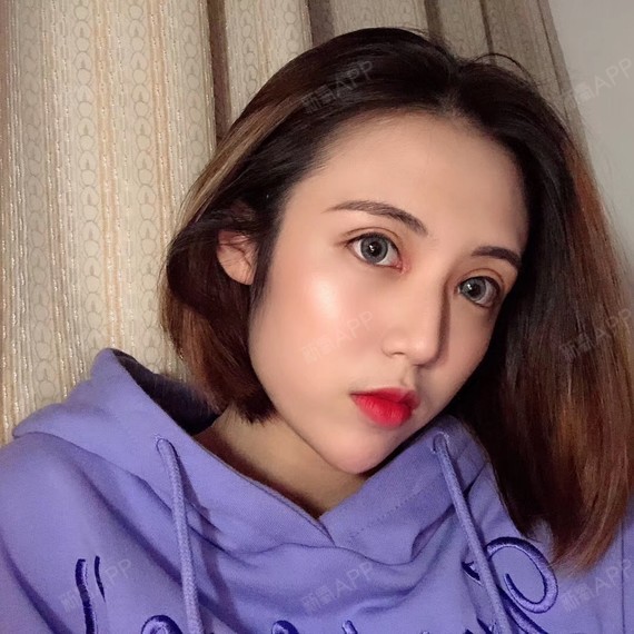 红妆尚【芭比大眼】术后15天:小姐姐们应该都可以看_圈子-新氧美容