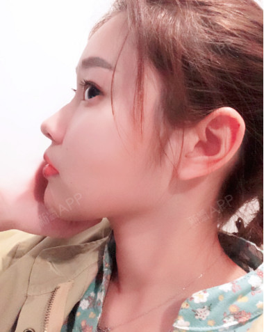 瘦脸针打完一个月了,效果还是有的,不过呢咬肌还是有_圈子-新氧美容