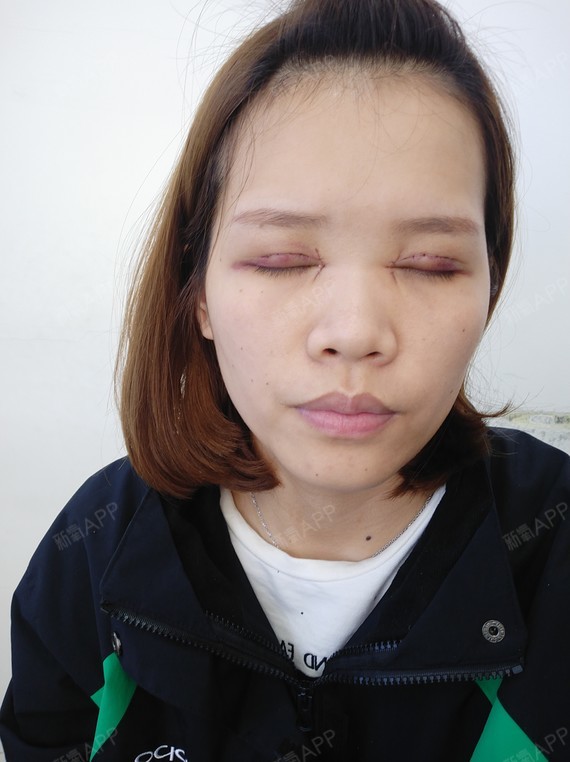 深圳埋线双眼皮好不好_效果图_氧气zu1bu埋线双眼皮术后第1天_新氧