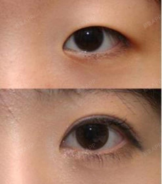 开外眼角,想变大眼的人必须知道的事