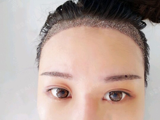 广西壮族自治区南宁种植眉毛好不好_效果图_氧气zorwk种植眉毛术后第6